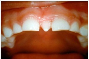 Gigi anak terlihat aneh 3