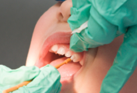 Mencegah Gigi Berlubang dengan Varnish Fluor