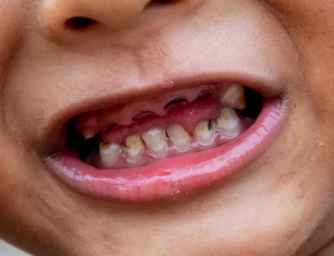 Bahaya Gigi Berlubang pada Anak 1
