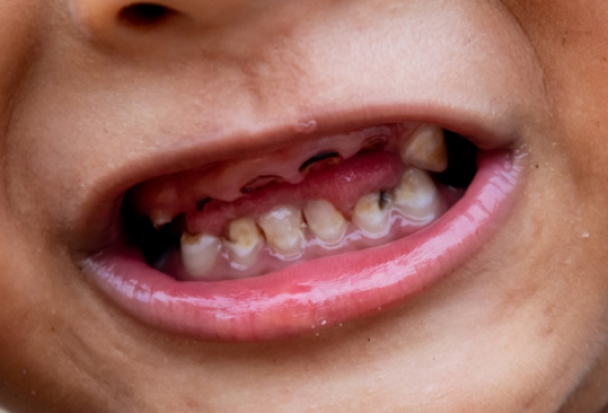Bahaya Gigi Berlubang pada Anak