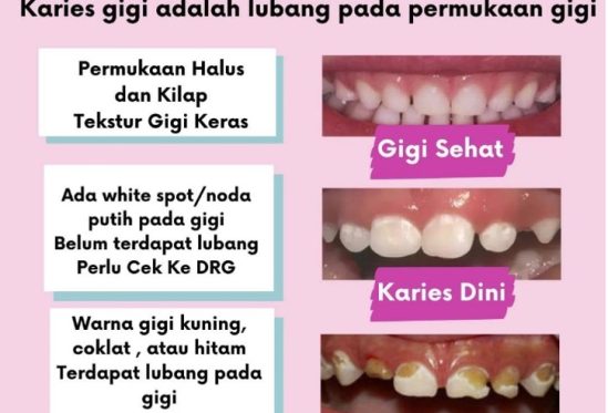 Gambaran Karies Gigi Anak Yang Harus Diwaspadai