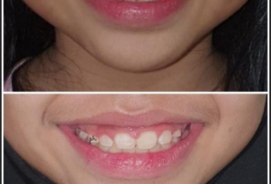 Berkenalan Dengan Gigi Berlebih Atau Mesioden