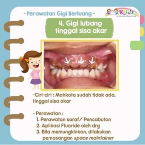 Perawatan Gigi Berlubang 3