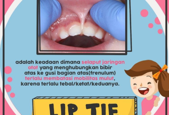 Berkenalan Dengan Lip Tie