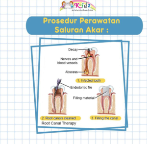 Perawatan Syaraf Gigi 3