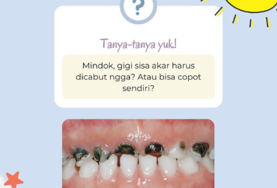 Gigi Sisa Akar Harus Diapakan?