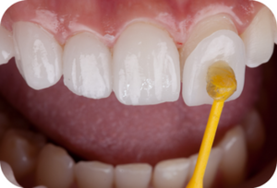 Apa Beda Bleaching dan Veneer?