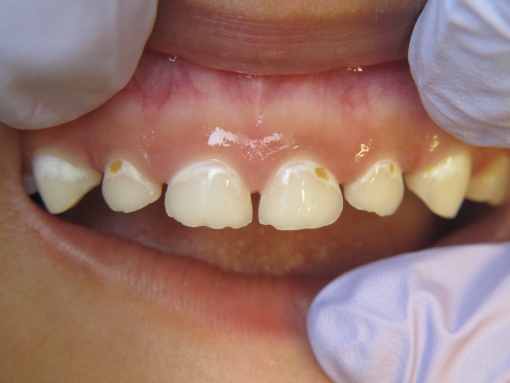 gigi putih berlubang